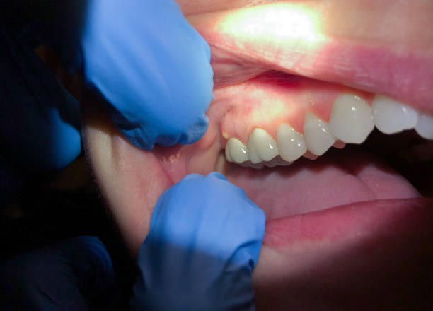 Best Emergency Dentist for Lost Fillings or Crowns in Spring Glen, UT